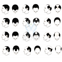 【佳學(xué)基因檢測(cè)】過早<font color='red'>脫發(fā)</font>、掉發(fā)太多怎么辦？你的方法可能是錯(cuò)的！